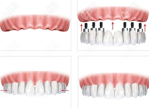 韩国登腾allon4全口种植牙