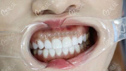 做美国皓圣种植体三个月效果图片