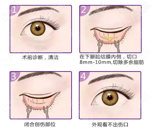 陈振雨做眼部整形的流程
