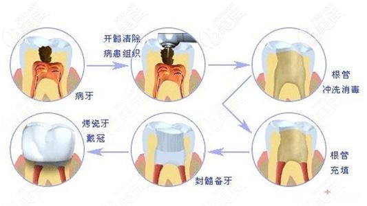 根管治疗的步骤