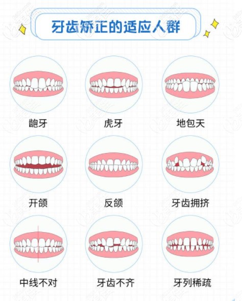 牙齿矫正适应的人群 牙齿矫正适应的人群