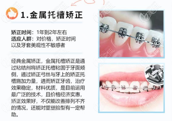 金属托槽矫正价格实惠效果好 金属托槽矫正价格实惠效果好
