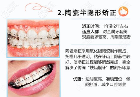 陶瓷半隐形矫正优势 陶瓷半隐形矫正优势