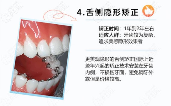 舌侧隐形矫正价格较高 舌侧隐形矫正价格较高