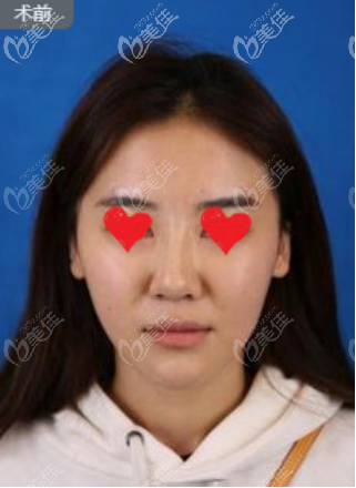 鼻部术前照 鼻部术前照