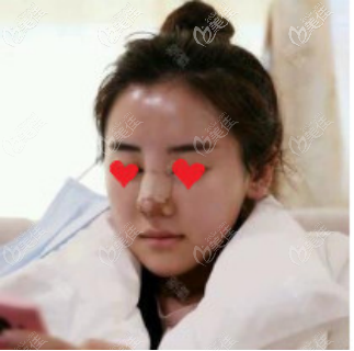 贴着胶带的鼻子 贴着胶带的鼻子