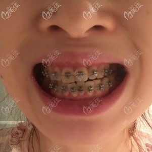 金属托槽正畸三个月效果