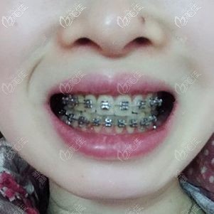 金属托槽正畸九个月效果