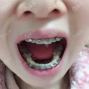 金属托槽正畸一年效果