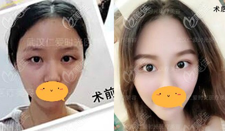 时光全切双眼皮案例效果对比图