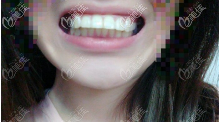 门牙前凸的图片 门牙前凸的图片