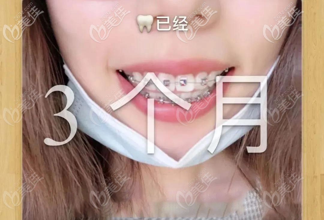 3个月后的牙齿变化情况 3个月后的牙齿变化情况