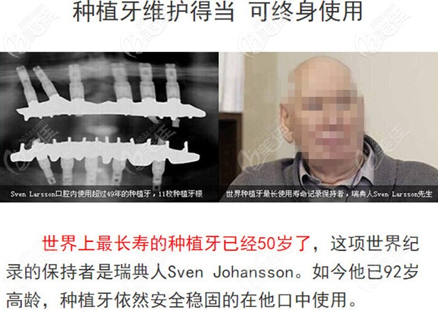 种植牙的寿命 种植牙的寿命