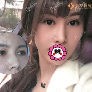 金华瑞丽蒋劲文隆鼻案例