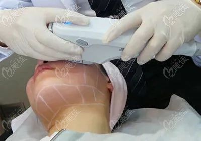 fotona4d眼周除皱治疗 fotona4d眼周除皱治疗