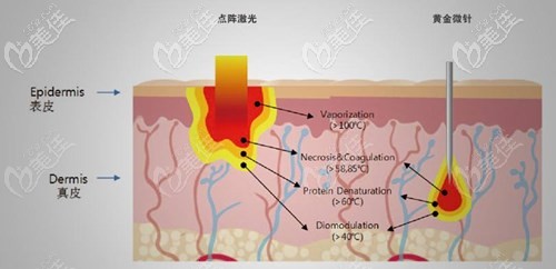 黄金微针和点阵激光的治疗区别