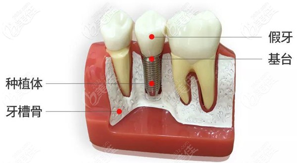 骨质疏松症并不是种植牙的相对禁忌症