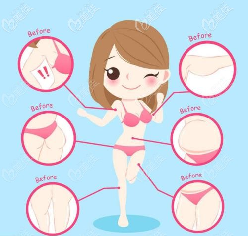 360环吸适合的部位