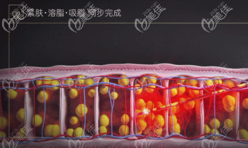 溶脂加吸脂,高效去脂 溶脂加吸脂,高效去脂