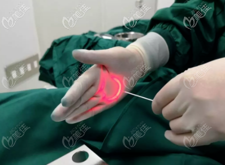 环形出光 环形出光