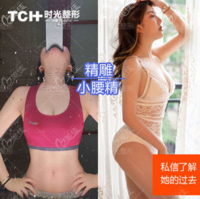 重庆时光腰腹吸脂案例 重庆时光腰腹吸脂案例