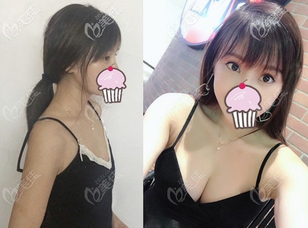 成都恒博天姿自体脂肪丰胸案例效果