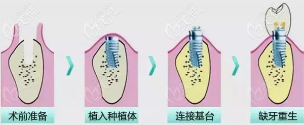 关于韩国种植牙质量的介绍
