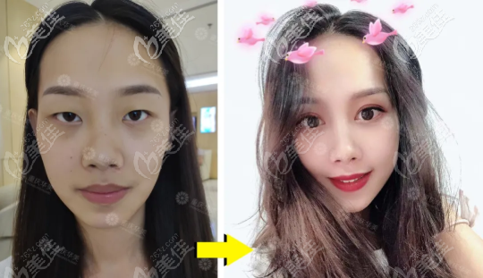 重庆华美眼鼻案例 重庆华美眼鼻案例