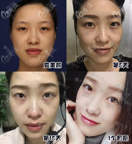 重庆华美祛斑案例 重庆华美祛斑案例