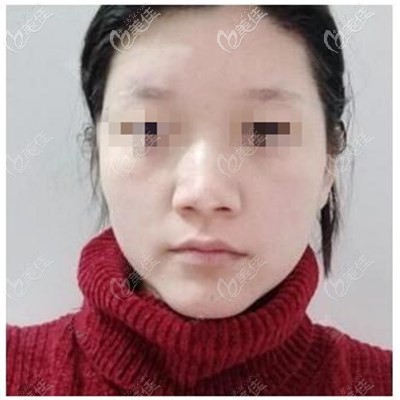 假体隆鼻手术前 假体隆鼻手术前