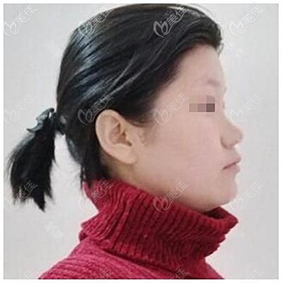 假体隆鼻手术前 假体隆鼻手术前