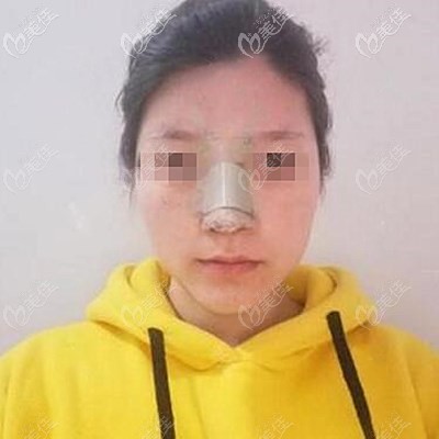 鼻综合术后第三天 鼻综合术后第三天