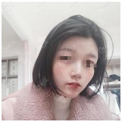 鼻综合术后3个月 鼻综合术后3个月