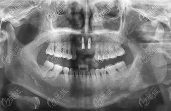 上门牙缺失4颗种植方案 上门牙缺失4颗种植方案