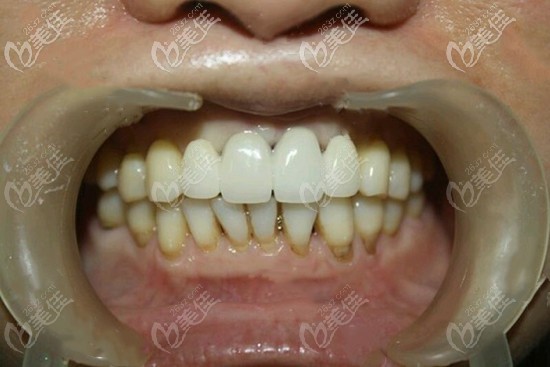 门牙缺失四颗种植案例图片 门牙缺失四颗种植案例图片