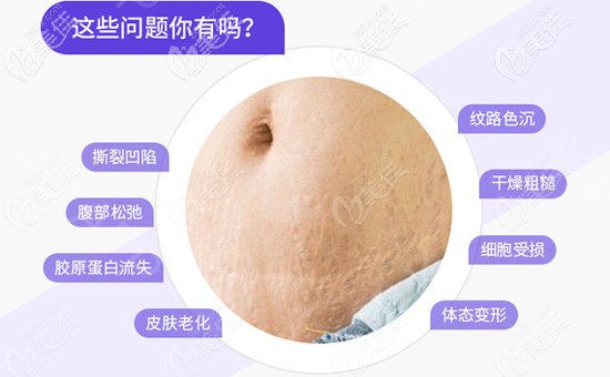 产后如何去掉妊娠纹？