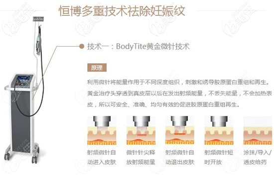 成都恒博BODYTITE半岛黄金微针去除妊娠纹