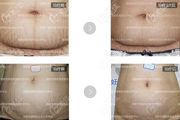 成都恒博医院祛除妊娠纹的案例效果对比图