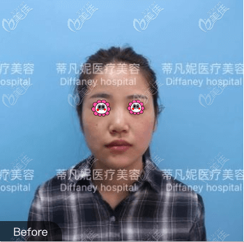 在北京蒂凡妮做肋软骨鼻综合前 在北京蒂凡妮做肋软骨鼻综合前