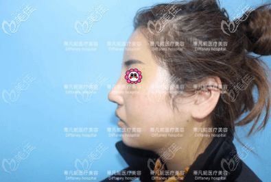 我做肋软骨鼻综合手术有18天了 我做肋软骨鼻综合手术有18天了