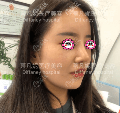 术后一个月多一日样子 术后一个月多一日样子