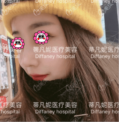 靳玉彪给我做的肋软骨鼻综合效果 靳玉彪给我做的肋软骨鼻综合效果