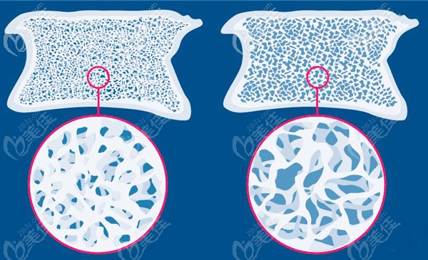骨质疏松症对种植牙的影响