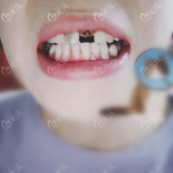 分享我在济南美奥口腔种植上门牙的亲身经历