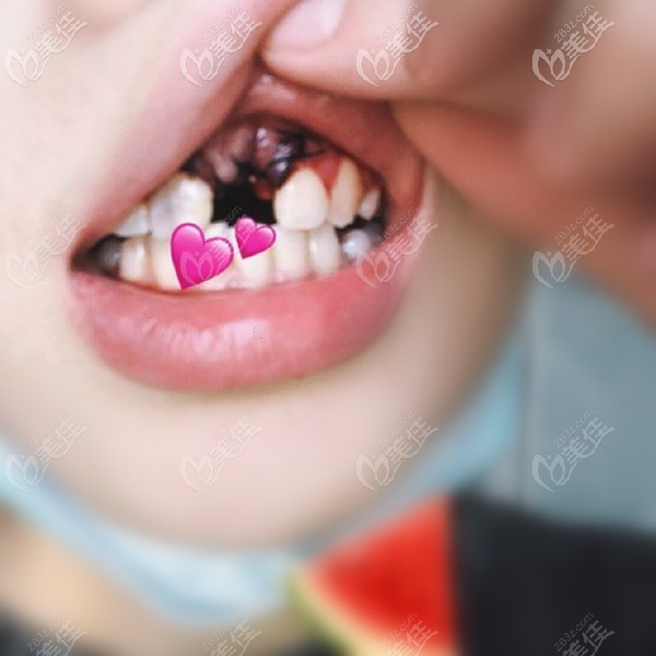 门牙拔除残根后缝合 门牙拔除残根后缝合