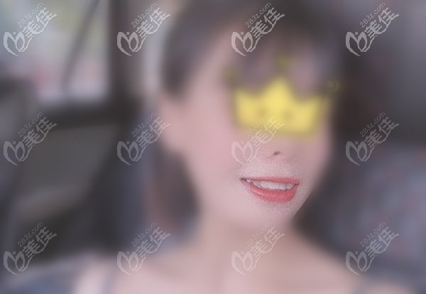 门牙种植恢复后照片 门牙种植恢复后照片