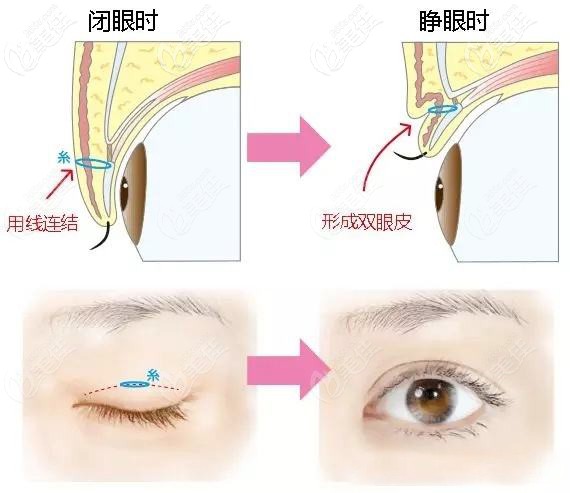 单眼皮变双眼皮是用线连结出褶皱