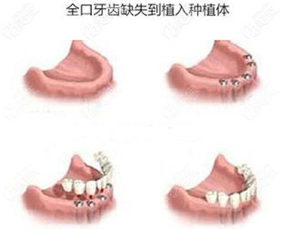全口缺失种植牙的示意图 全口缺失种植牙的示意图
