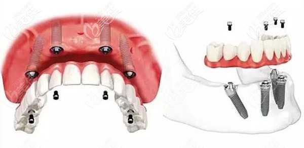 无牙颌种植allon4的技术 无牙颌种植allon4的技术