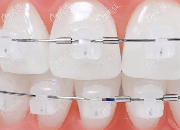 半隐形陶瓷矫正